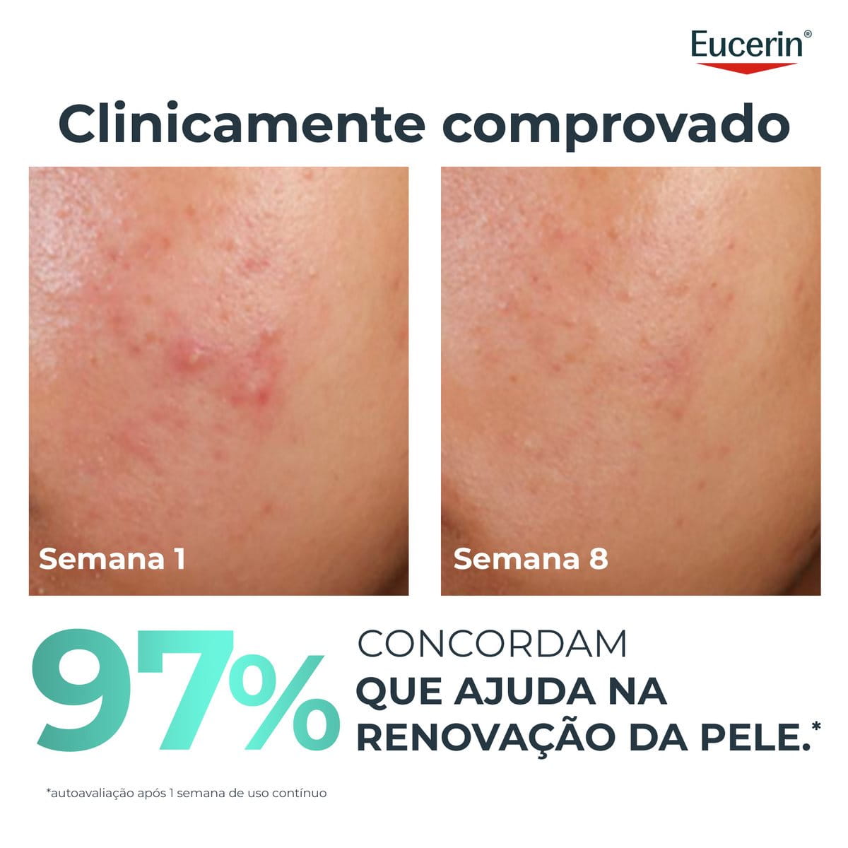 DERMOPURE CLINICAL Peeling 10 | Pele Propensa a Acne